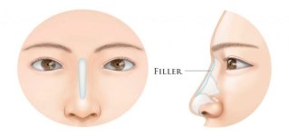 nose-filler-graphic-1024x536-1.jpg nose-filler-graphic-1024x536-1.jpg