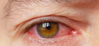 What-Is-Dry-Eye-Symptoms-Treatment-Causes-1.jpg