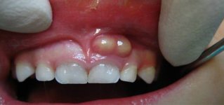 أسباب-ظهور-الحويصلات-الصديدية-باللثة-وتأثيرها-على-الاسنان.jpg